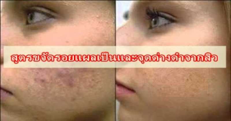 อยากหน้าใสต้องอ่าน  7 สูตรขจัดรอยแผลเป็นและจุดด่างดำจากสิวที่คุณทำได้ด้วยตัวเอง